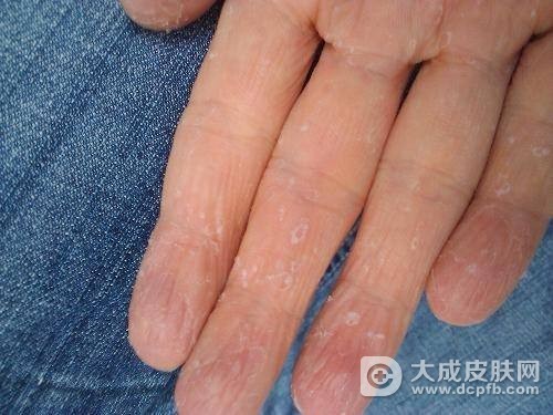 手掌脱皮应该要怎么治