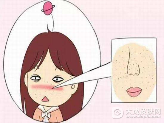 酒渣鼻