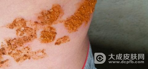 带状疱疹的保健护理
