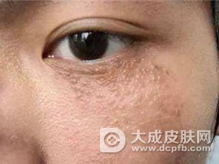 眼部有扁平疣要注意什么