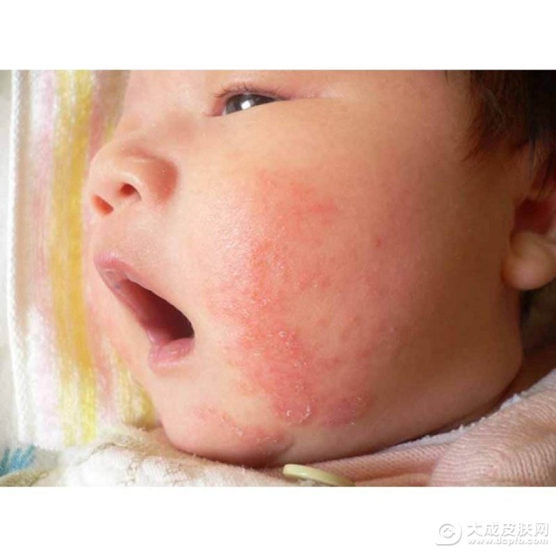 宝宝身上的湿疹要怎么护理比较好