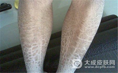鱼鳞病好治吗