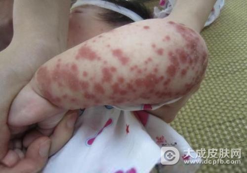 皮疹的预防与治疗