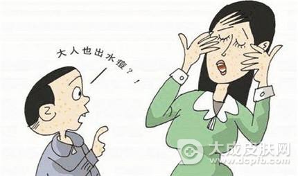 水痘和带状疱疹是一种吗
