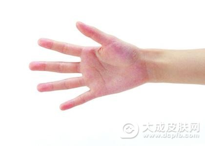 手上长湿疹应该怎么办
