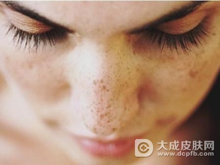 脸上的黄褐斑怎么能去掉