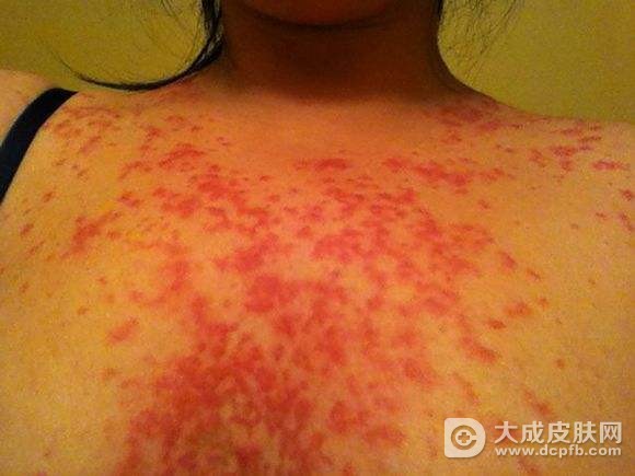 玫瑰糠疹的医治