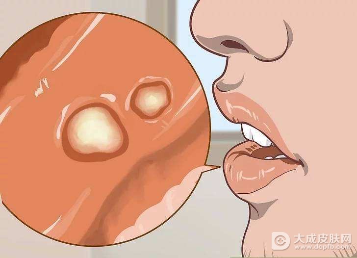 口腔溃疡吃什么水果比较好