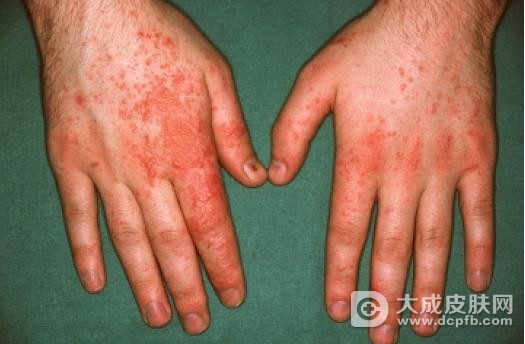 皮炎湿疹的危害及护理