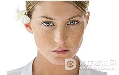 脸上的黄褐斑怎么才能后去掉