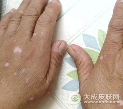 白癜风的日常注意事项