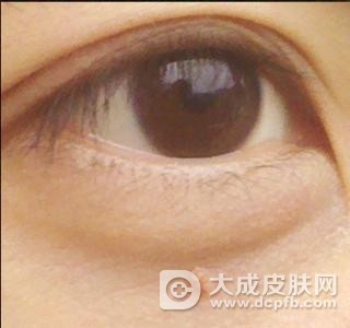脸上长扁平疣怎么能去掉