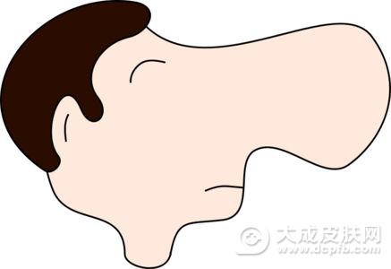酒渣鼻可以预防