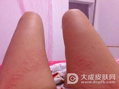 荨麻疹会传染吗