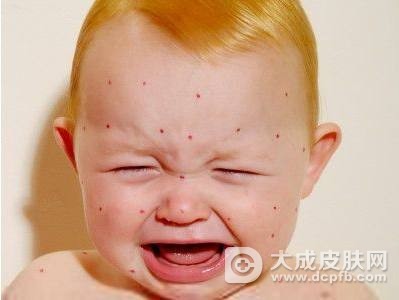 宝宝身上长痱子,这样护理