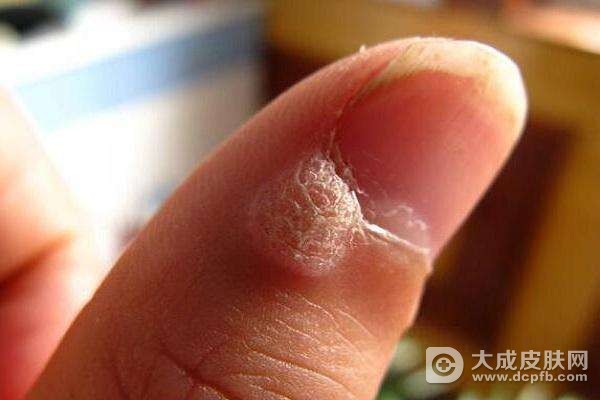身上长了扁平疣怎么治疗好