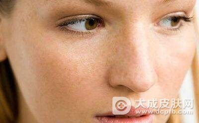 脸部长晒斑注意什么
