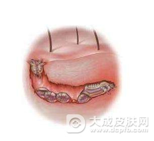 疥疮的症状表现。