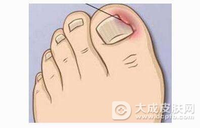 甲沟炎化脓了怎么办