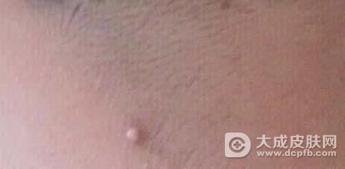 脖子上长小肉粒的病因