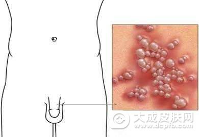 男性生殖器疱疹的症状及危害