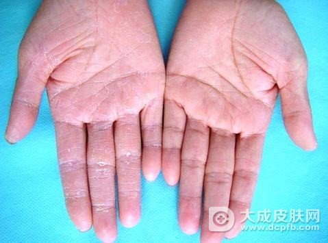 手足癣病怎么治疗