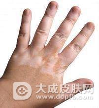 白癜风的护理方法