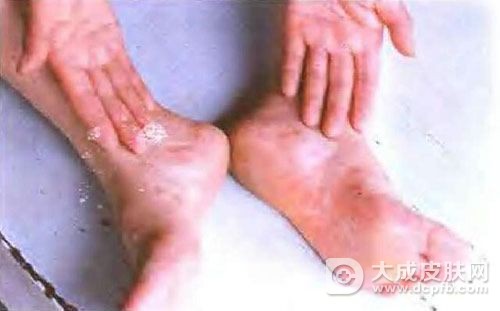 梅毒的早期症状都有哪些