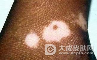 白癜风的发病特征有什么