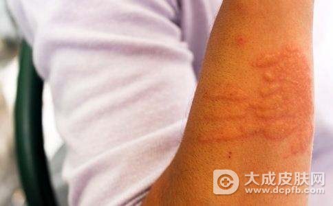 慢性荨麻疹应该怎么治疗