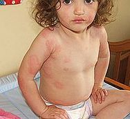 小儿荨麻疹该怎么治
