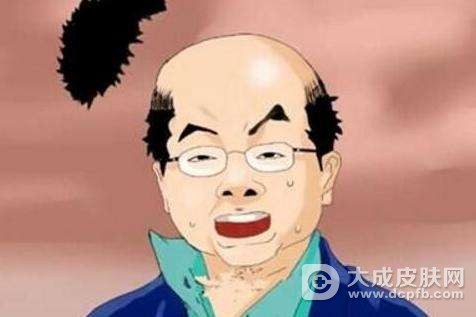 斑秃患者怎么治