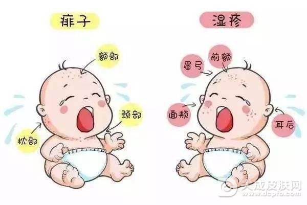 痱子湿疹