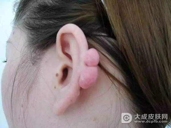 瘢痕疙瘩能不能治愈