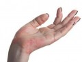 湿疹的几种发病因素