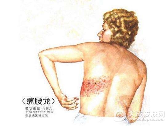 带状疱疹的病因