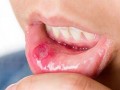 口腔溃疡疾病能预防吗
