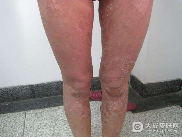 牛皮癣的保健治疗