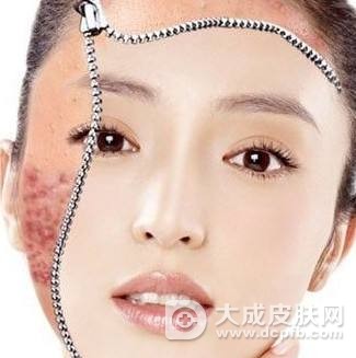 脸上的痘印怎么办