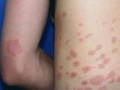 孩子患上玫瑰糠疹可能会引发的危害性