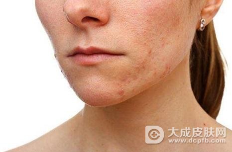 成人脸部长了湿疹怎么办