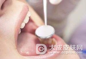口腔溃疡的护理方法