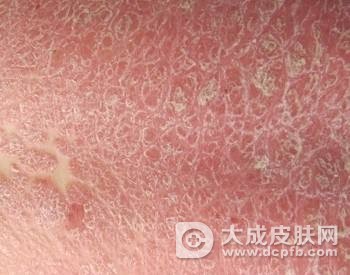牛皮癣的发病症状