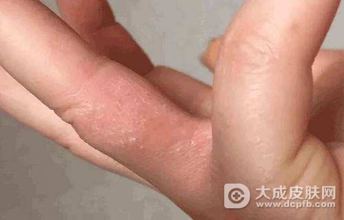 手上长小水泡很痒怎么办