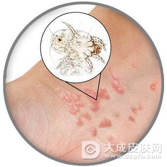 疥疮的发病特征