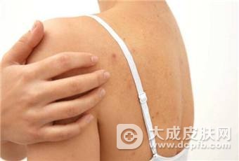 过敏性皮炎怎么治疗好