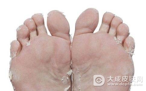 脚底蜕皮什么原因造成的
