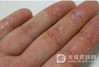 慢性皮炎湿疹是怎么造成的