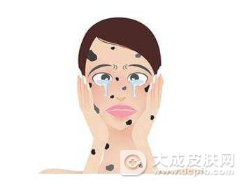 黄褐斑的形成原因你知道吗