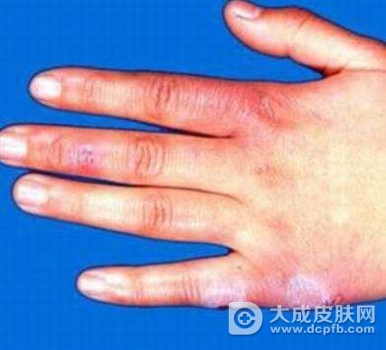 结节性红斑怎么治最好